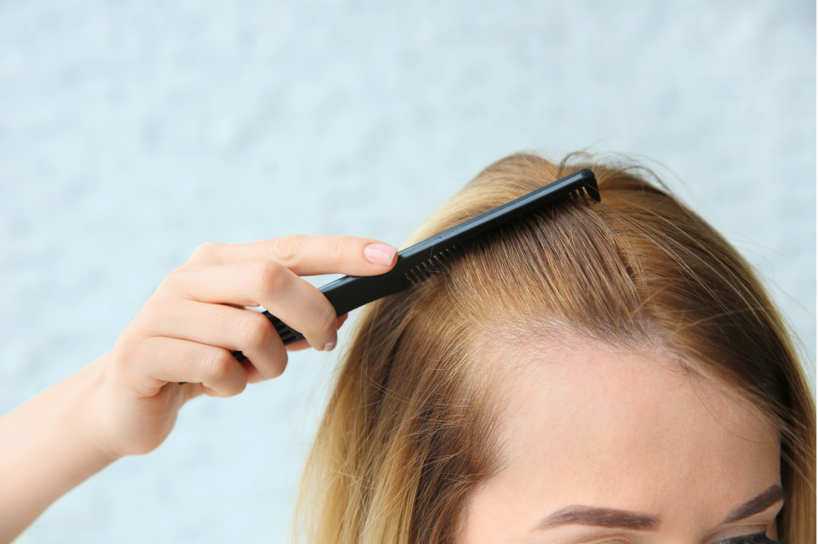 Female Pattern Hair Loss (Androgenetic Alopecia)