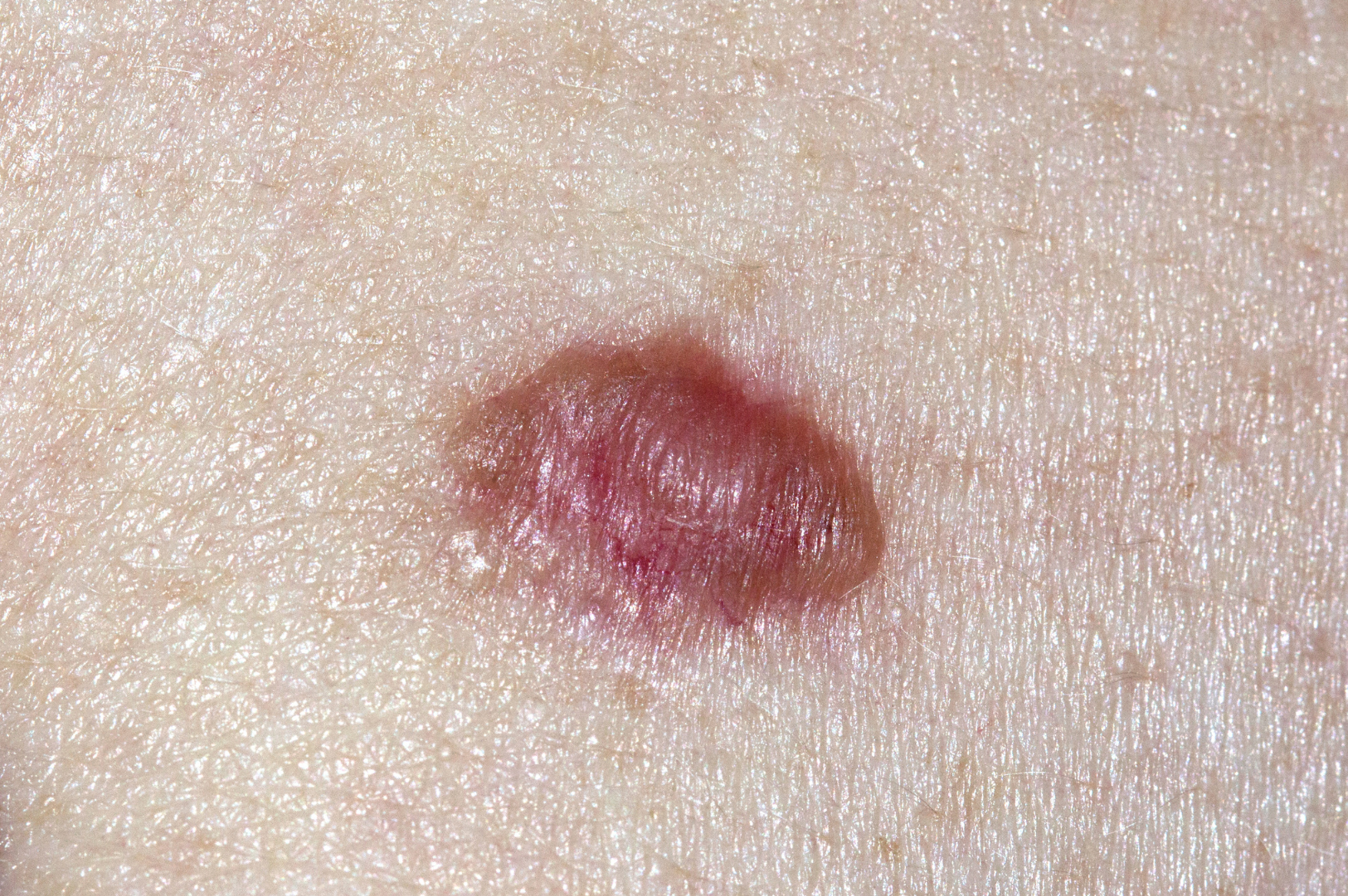 Merkel Cell Carcinoma