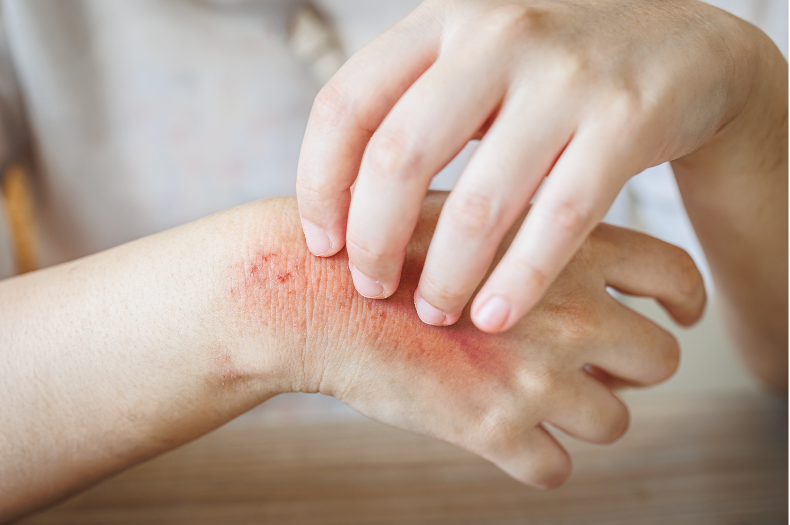 Parasitic Infections (e.g; Lice, Scabies, etc.)