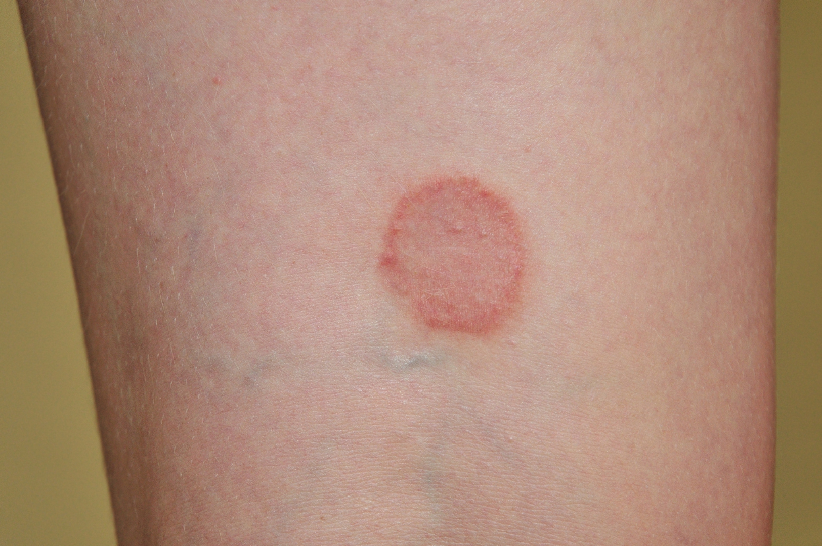 Ringworm (tinea)