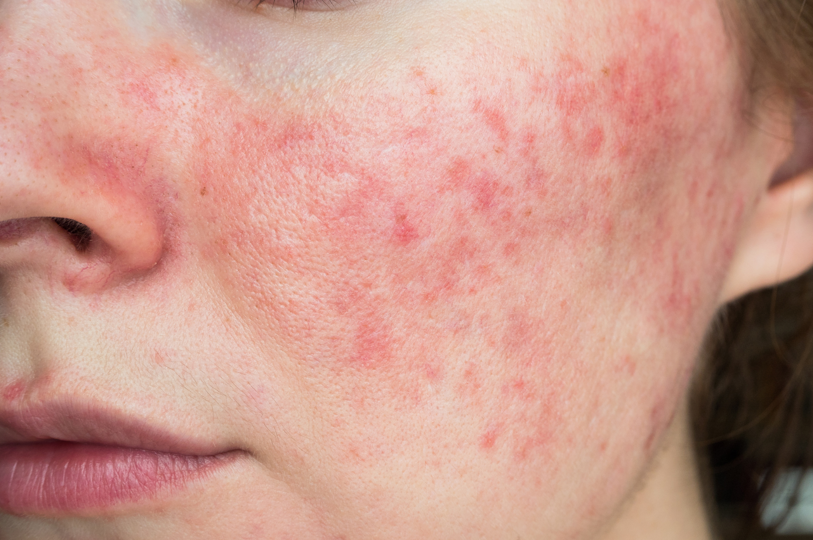 Rosacea