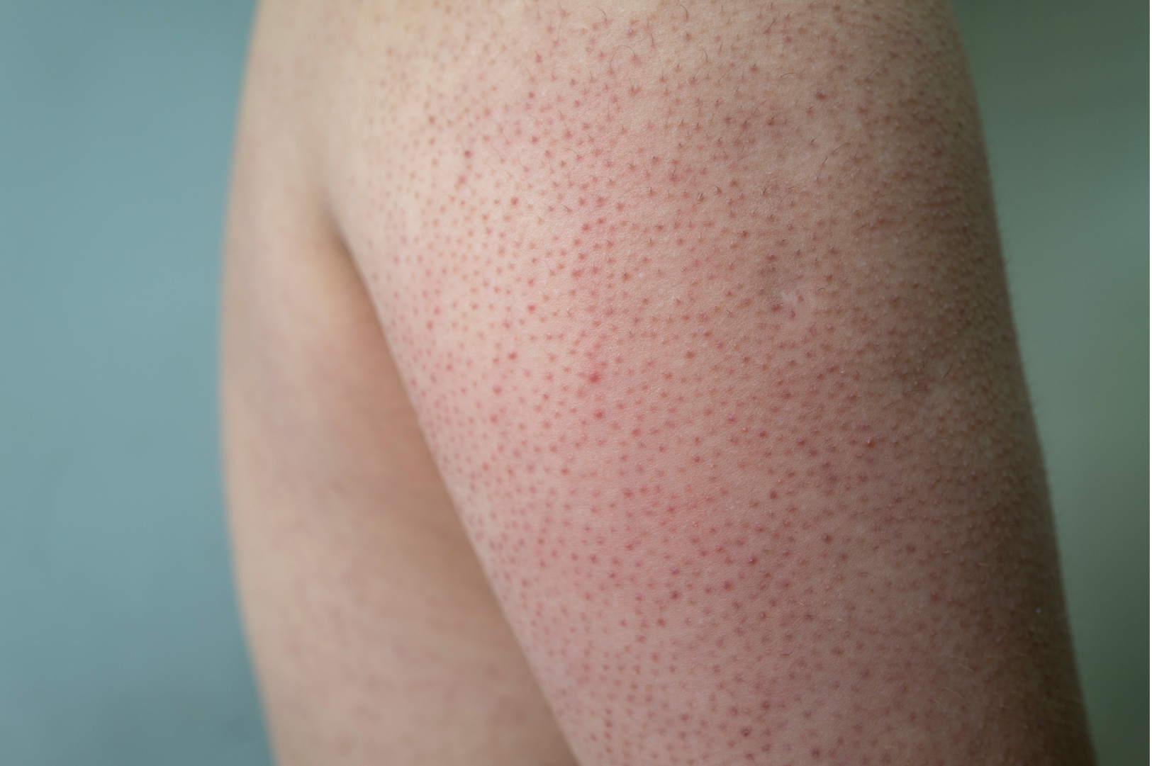 Seborrheic Keratosis