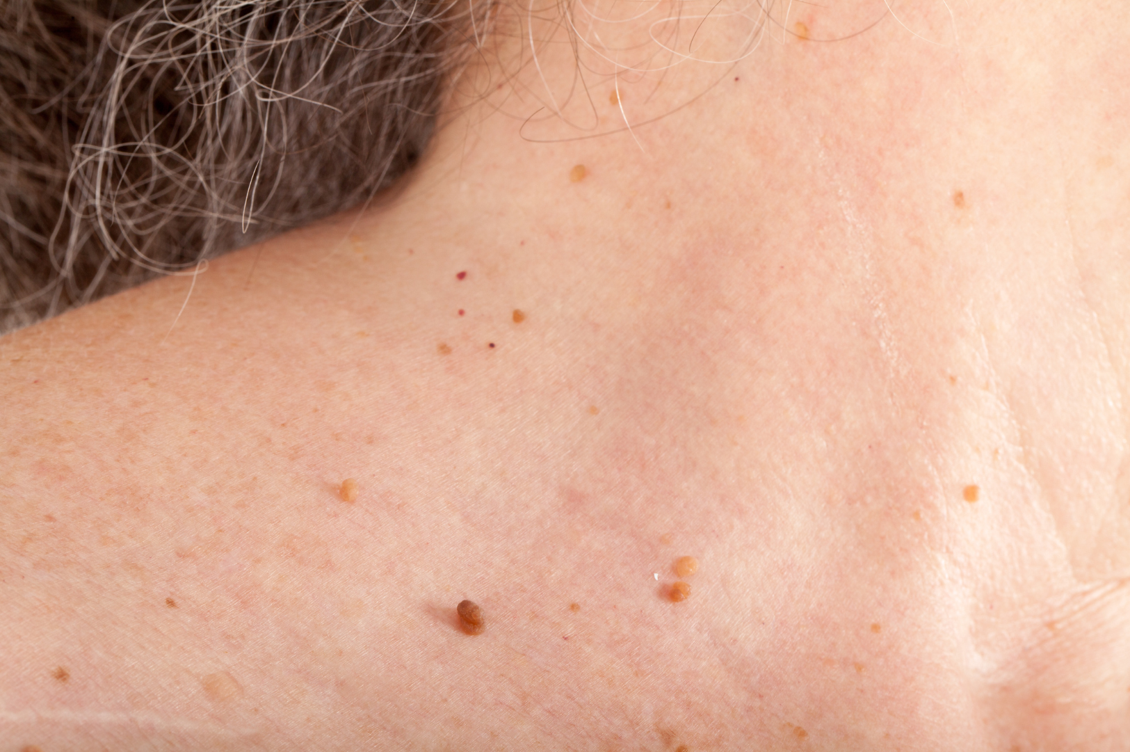 Skin Growths