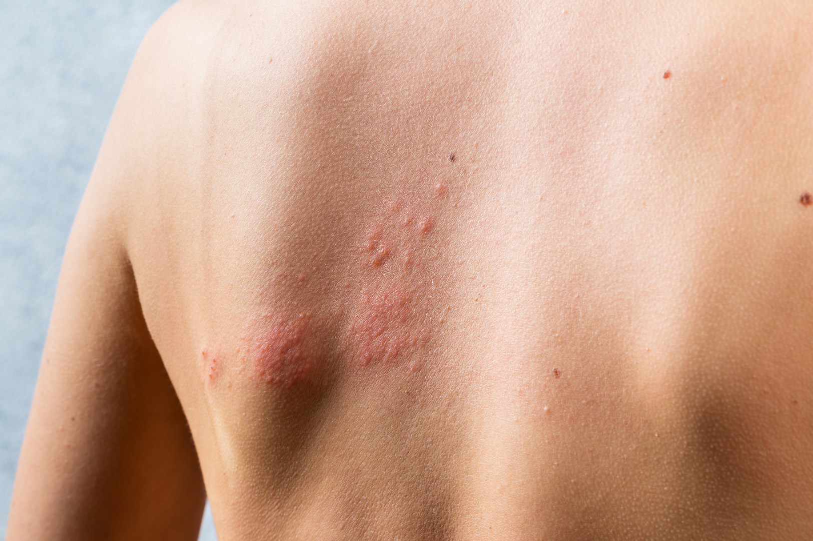 Rashes caused by a bacterial or fungal infection
