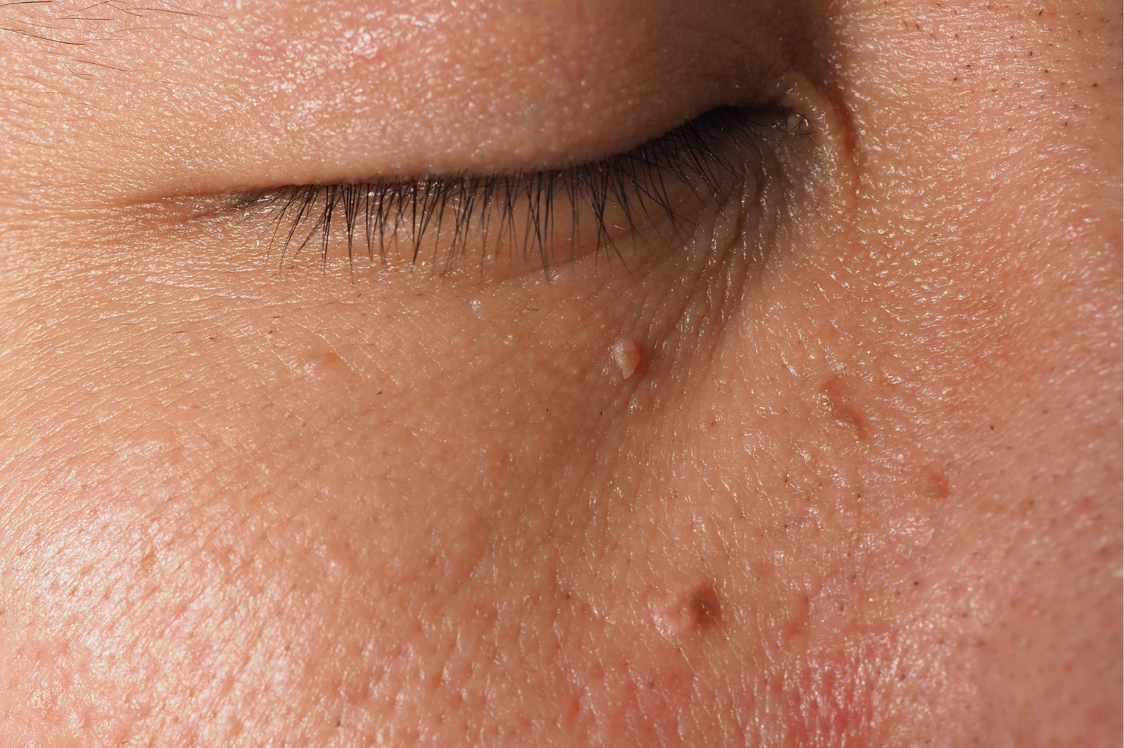 Skin Tags (Acrochordons)