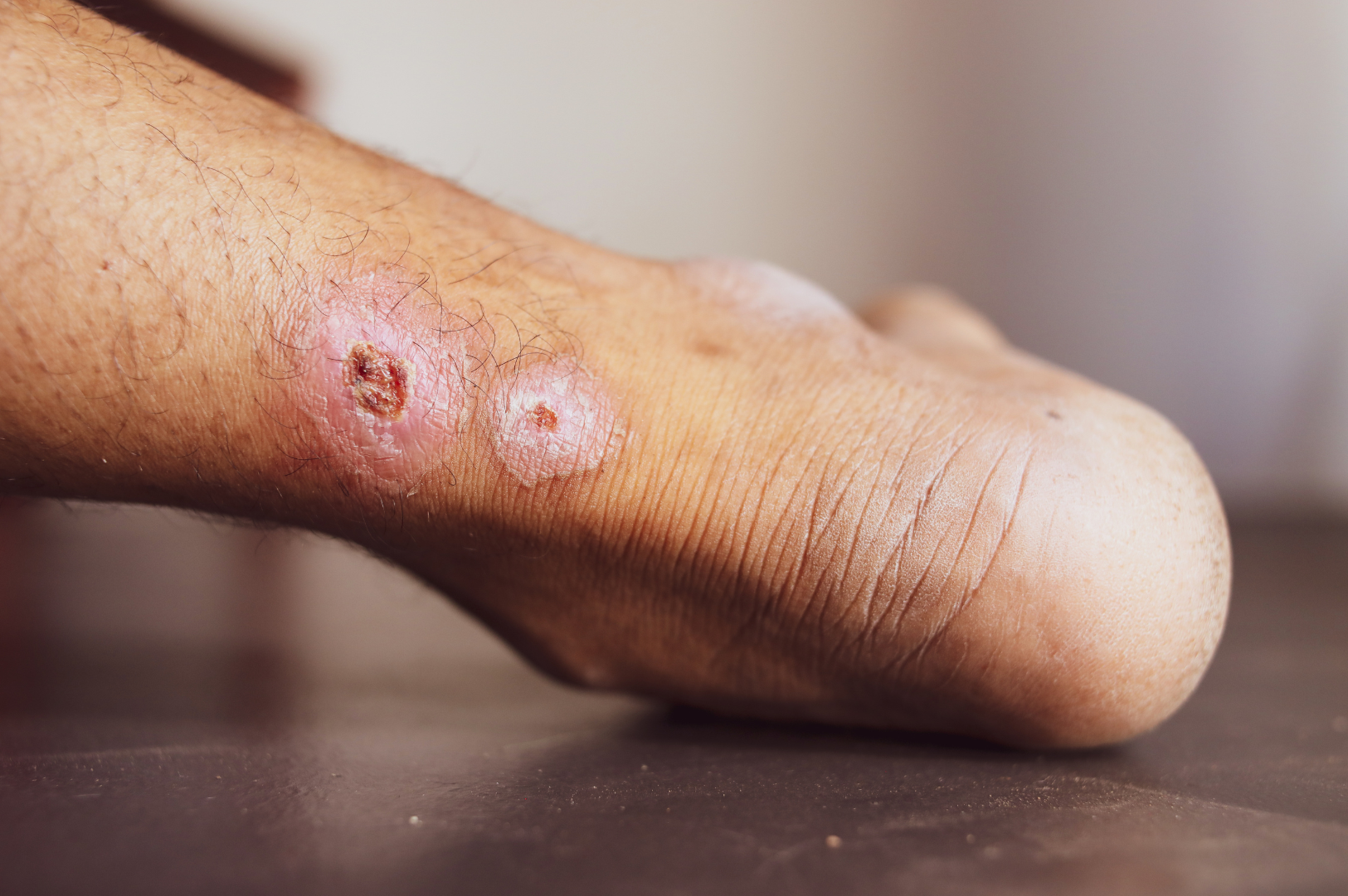 Skin Ulcers