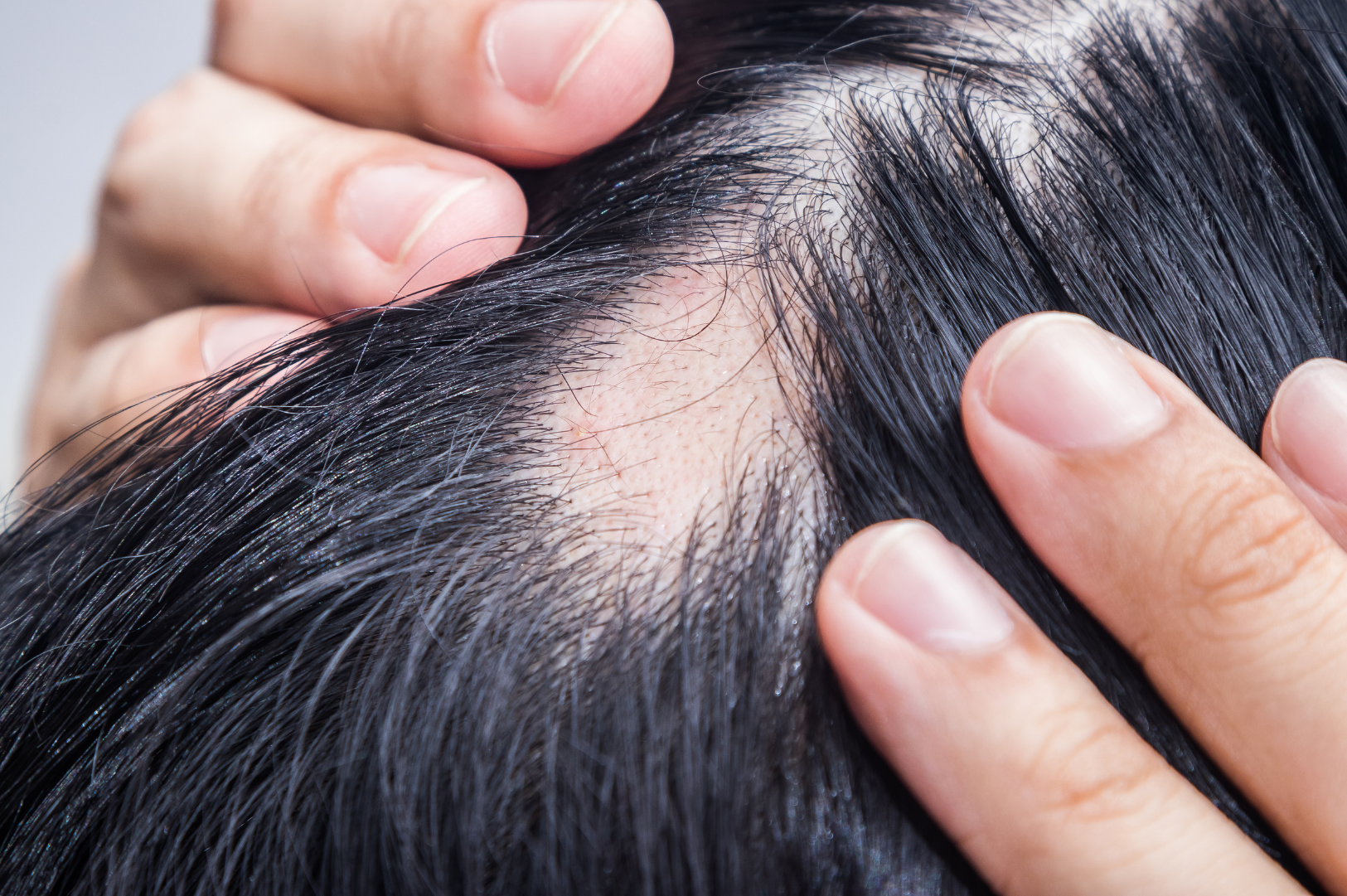 Traction Alopecia