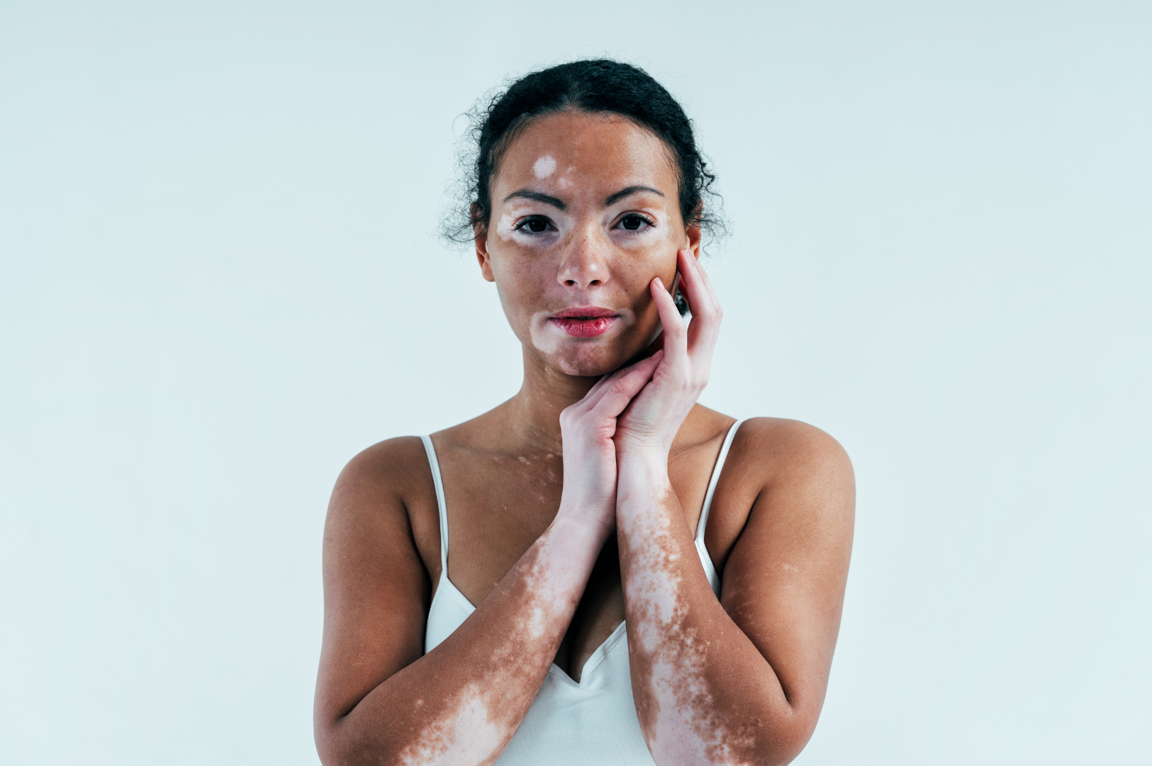 Vitiligo